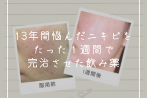 皮膚科で治らないニキビを1週間で完治させたトレティヴァの経過、各分量による副作用の違い、購入方法